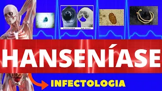 HANSENÍASE - CAUSA, SINTOMAS, DIAGNÓSTICO E TRATAMENTO - INFECTOLOGIA