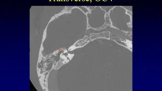 Temporal Bone Pathology 10: Trauma