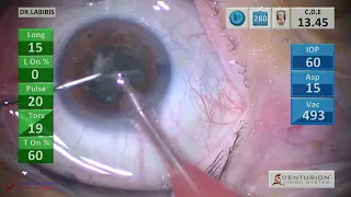 Digital-guided Trifocal-Toric IOL implantation in a small pupil
