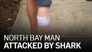 Santa Rosa Man Suffers Shark Attack in Miami