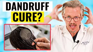 HOW TO GET RID OF DANDRUFF WITH TREATMENT HOME! - WHAT THE SHAMPOO COMPANIES DONT WANT YOU TO KNOW!
