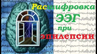 Как расшифровать заключение своей ЭЭГ при эпилепсии или подозрении на нее