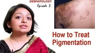 How to Treat Skin Pigmentation- Episode 3