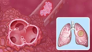 Understanding Non-Small Cell Lung Cancer