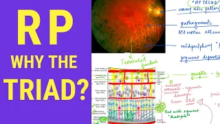 Retinitis Pigmentosa - WHY the triad?