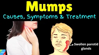 Mumps: Symptoms, Causes, Treatments and Complications