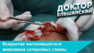 Вскрытие нагноившегося жировика (атеромы) спины