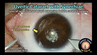 CataractCoach 1290: uveitic cataract with synechiae