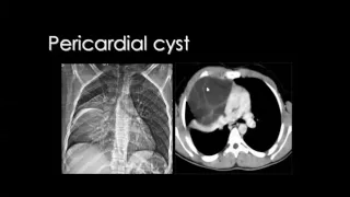 Imaging of Mediastinal lesions   DRE 5   Dr Mamdouh Mahfouz