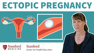 What is an ectopic pregnancy? Doctor explains risk factors, symptoms, & treatment | Stanford
