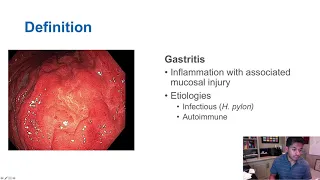 Gastritis vs. Gastropathy