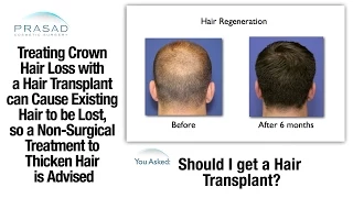 Male Pattern Baldness at the Crown can be Treated without a Risky Hair Transplant