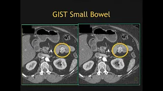 CT of Small Bowel GIST Tumors: Imaging and Theory Part 2