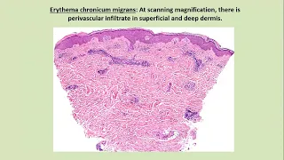 Lecture-132:  Lymes disease,  Actinomycosis, Botromycosis, Kawasaki disease. Rook's chapter 26.