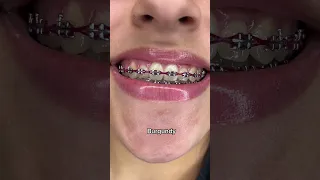 Best Braces Colors for Whiter Looking Teeth Part 1