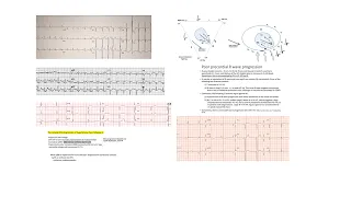 ECG QRS abnormalities- Part 1