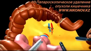 3D Лапароскопия Алматы. Лечение  рака толстого кишечника.