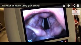 Intubation of patient using glide scope!