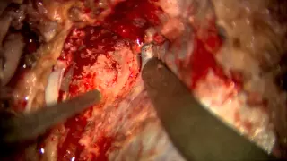 Trapping and V3–radial artery graft–V4 bypass for ruptured dissecting aneur. of the VA