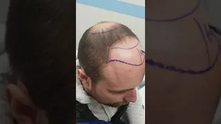 пересадка волос в Bellus Clinic