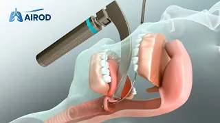 AIROD® difficult airway intubation
