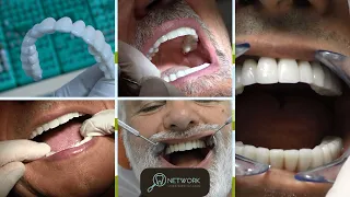 Impianti Dentali con poco osso senza osso circolari senza gengiva