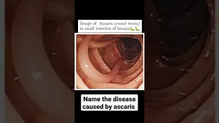 Human Health and Disease | Ascariasis | Round worm