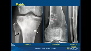 Imaging of Bone Tumors