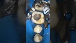 ¡INCREÍBLE caries profunda que llego al nervio de la muela!