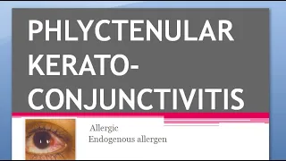 Ophthalmology PHLYCTENULAR KERATOCONJUNCTIVITIS KERATITIS TB Miliary Sacrofulous Fascicular Salzmann