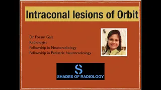 Intraconal lesions of Orbit -Simplified