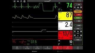 Ventricular Fibrillation with Defibrillation