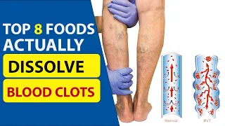 Top 8 Foods Actually Dissolve Blood Clots