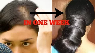 Say Goodbye to Hairfall with only 1 ingredient in just 3 days | Extreme Hair Growth