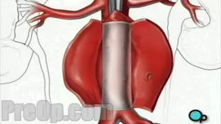 Abdominal Aortic Aneurysm - Open Repair PreOp® Patient Engagement and Education