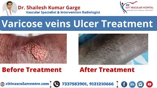 Varicose Ulcer Before And After Treatment | Varicose Veins And Ulcers | Must See!