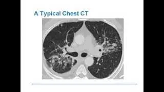 Management Strategies for Sarcoidosis