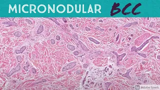 Micronodular Basal Cell Carcinoma (dermpath, dermatology, pathology, dermatopathology)