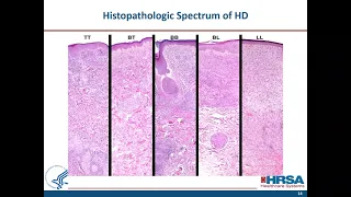 When to Suspect Leprosy: Clinical Aspects and Treatment of Uncomplicated Hansen's Disease