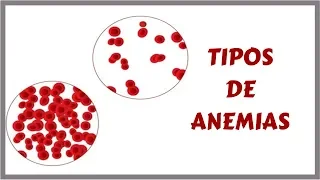 TIPOS DE ANEMIAS | Sinais, Sintomas e Tratamento