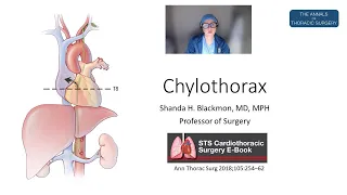 Chylothorax