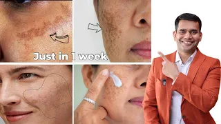 Pigmentation, Melasma, Dark Spot 100% Working Treatment - Dr. Vivek Joshi