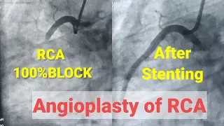 Primary Angioplasty of RCA, Stenting of RCA, 100% blcoked RCA