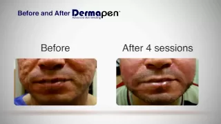 MicroNeedling Before and After - Dermapen® Treatment