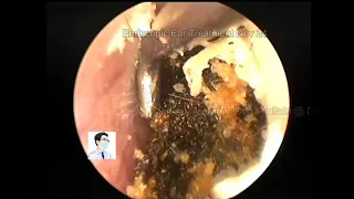 Reexamination of cholesteatoma of external auditory canal