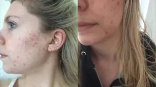 Vegan Diet Cause ACNE Compilation  (Vegan Phobic)