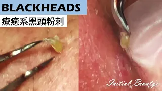 療癒系黑頭粉刺(soothing blackheads) - Taiwan Tainan台南清粉刺最乾淨