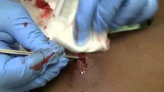 Big Abscess in the ER