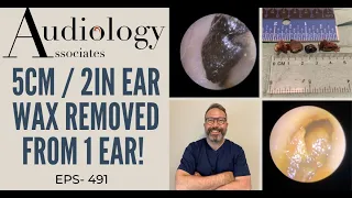 5CM/2IN EAR WAX REMOVED FROM 1 EAR - EP491