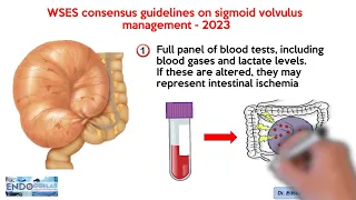 WSES consensus guidelines on sigmoid volvulus management - 2023